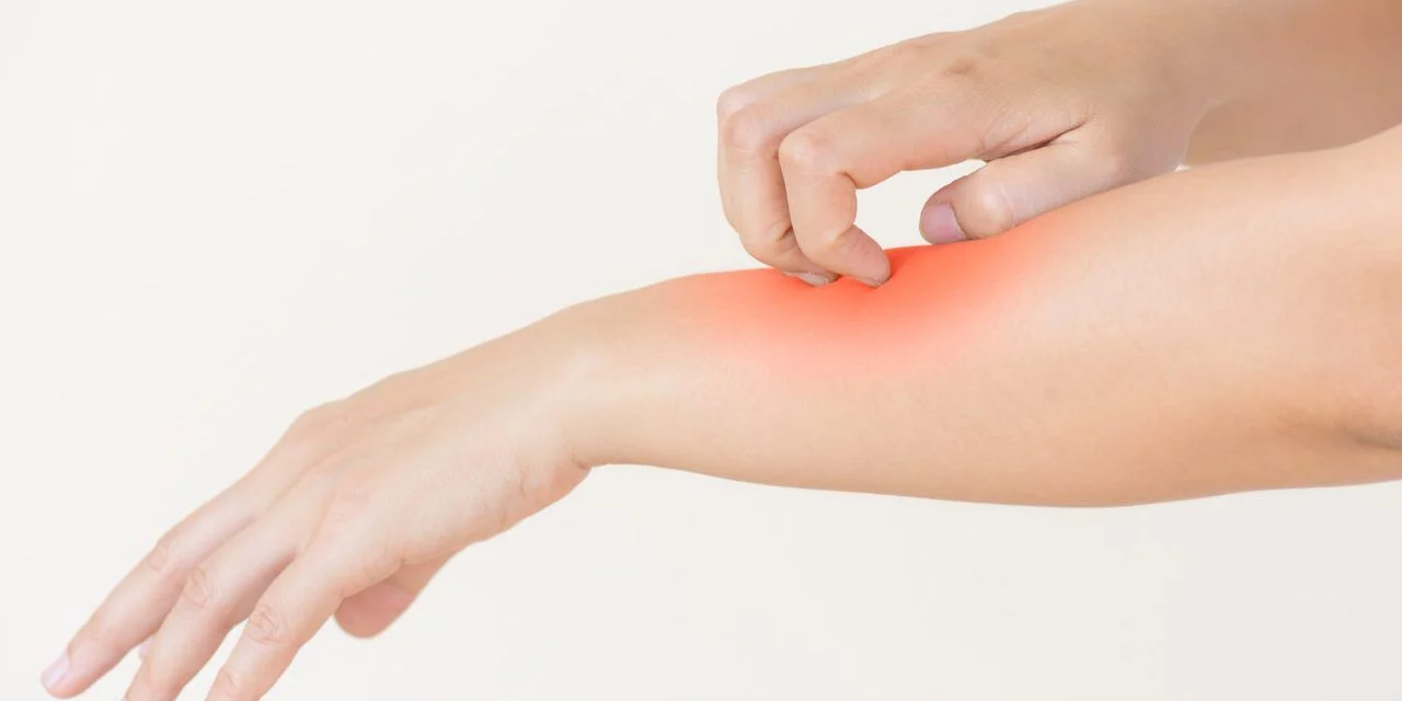 Todo sobre los eccemas en la piel