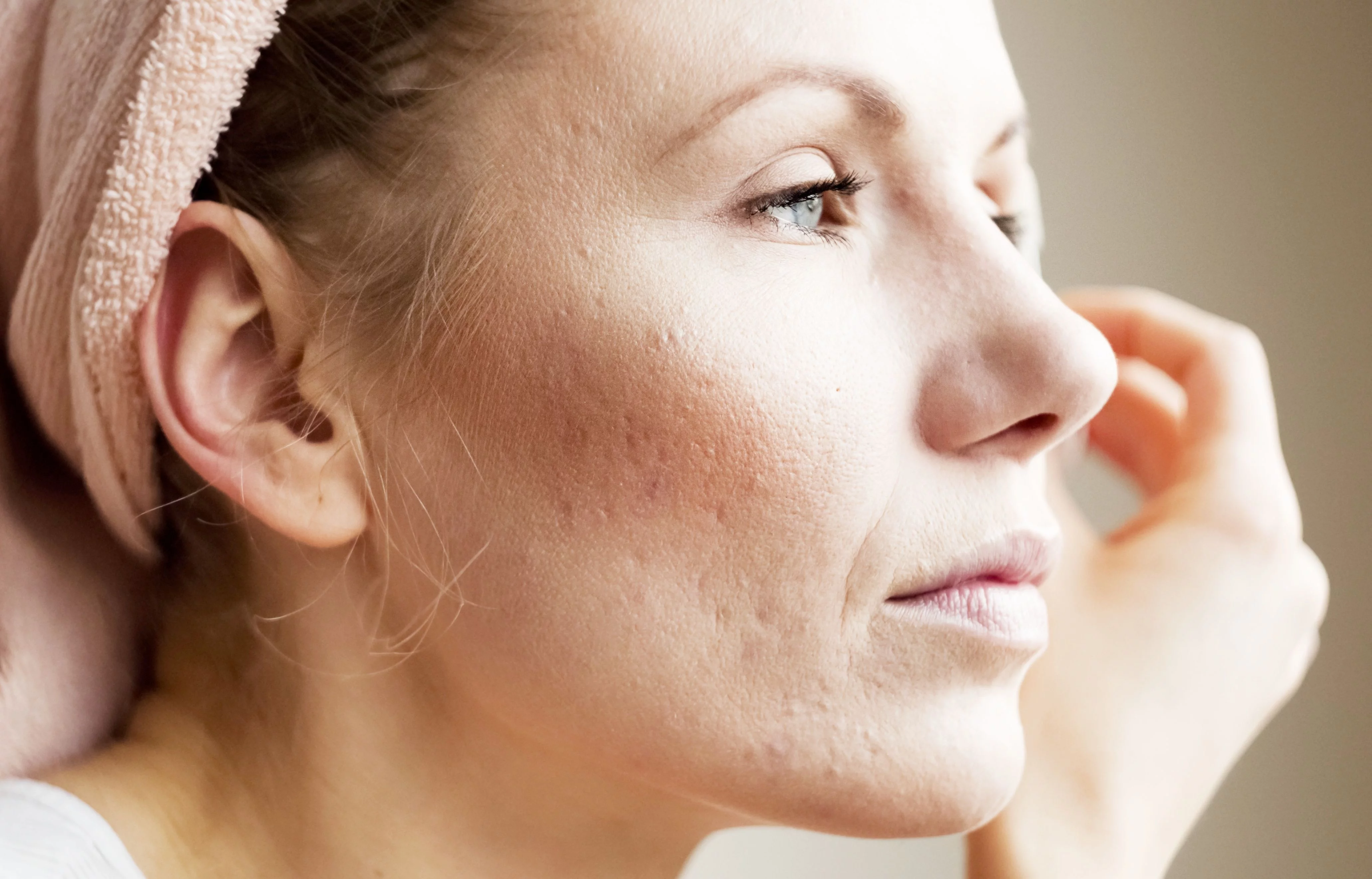 como-tratar-piel-rosacea