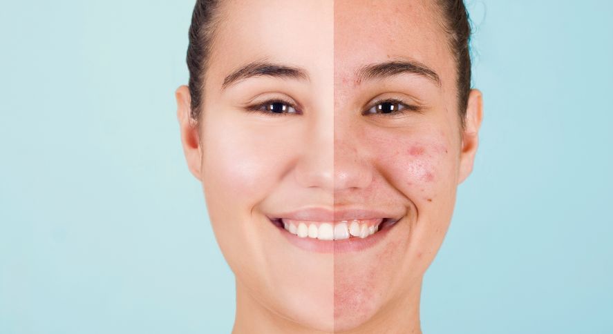 rutina facial anti acne